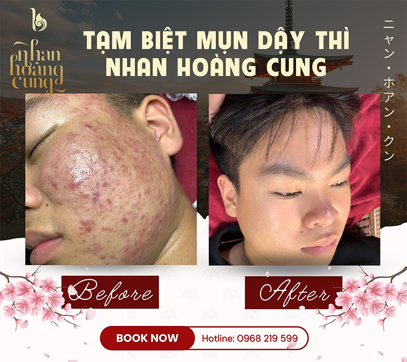 Điều trị mụn tuổi dậy thì 