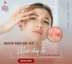 Điều trị mụn tuổi dậy thì